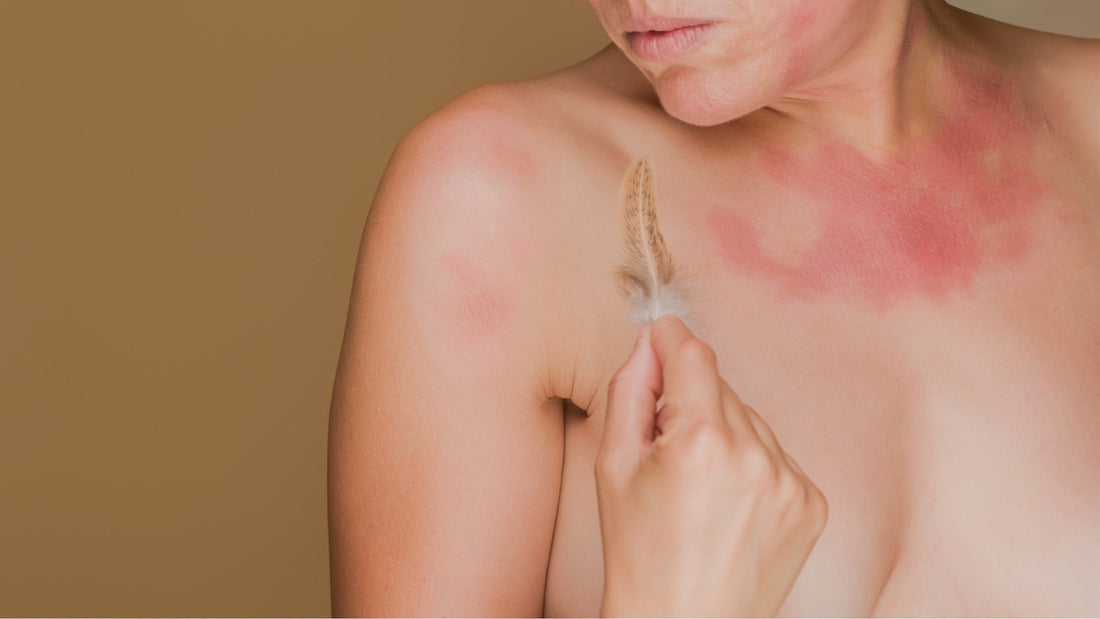 Beyond the Itch: Understanding Eczema and Finding Natural Relief