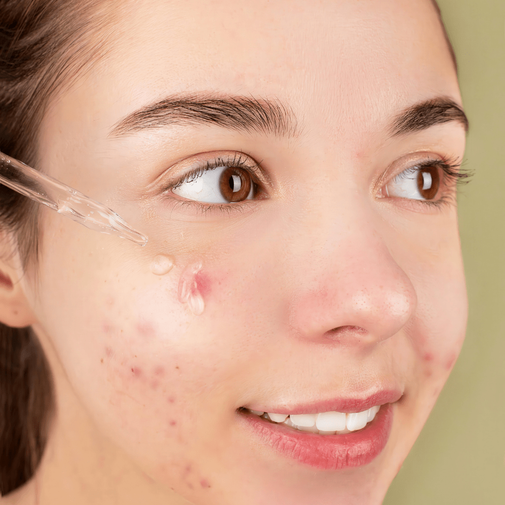 Pristine 5 Serum - Blemish Targeting Serum 30ml - Natural Skincare Moisture Serum