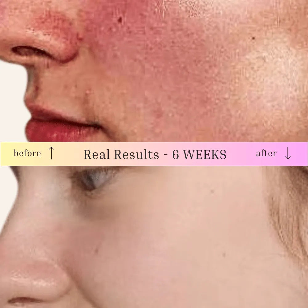 Acne Rescue & Balance Bundle - Face Skincare Pack - Lily Bee And Me Acne Rescue & Balance Bundle | Natural Blemish Control Face Skincare Pack jc0f5b-4d.myshopify.com